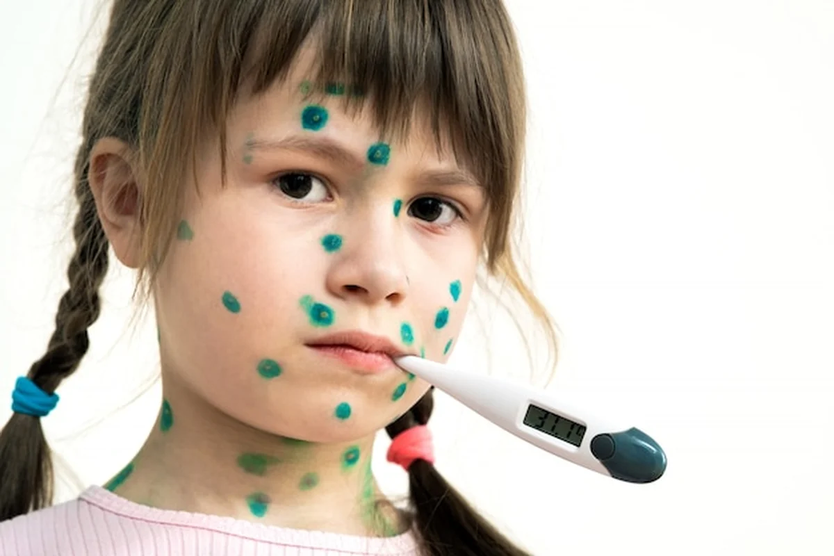 Dziewczynka z zielonymi wysypkami trzymająca termometr z gorączką